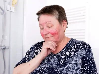 Čo pomáha na rosaceu? Základom je správne nastavená liečba