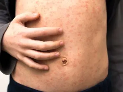 Ako vyzerajú osýpky? Spoznajte ich príznaky a prejavy | Medikament