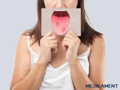 Piata choroba u detí, aj dospelých - príznaky, priebeh, liečba 