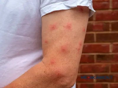 Uštipnutie hmyzom - ako zmierniť opuch, bolesť alebo svrbenie?