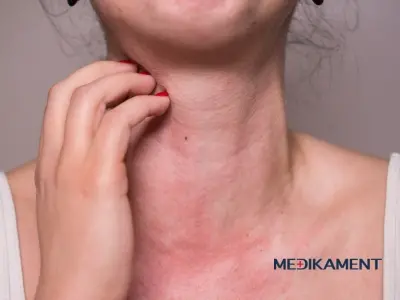 Alergia na slnko (fotodermatóza) – Príznaky, príčiny a liečba