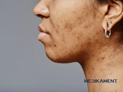 Čo pomáha na pigmentové škvrny – príčiny, prevencia a liečba