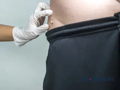 Fibróm: všetko, čo potrebujete vedieť o príznakoch a liečbe