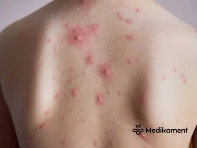 Očkovanie proti kiahňam – kto sa môže dať zaočkovať a kedy?