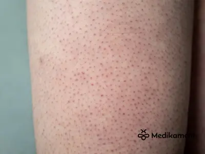 Čo je keratóza a prečo sa objavuje na koži? Príčiny a riziká