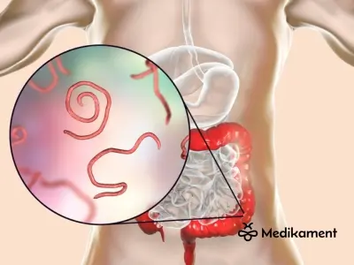 Mrle u detí – nočná mora pre predškolákov! Naučte sa, ako ich liečiť doma