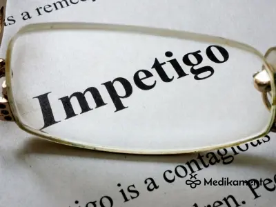 Impetigo u detí a dospelých. Príznaky, diagnostika a liečba.