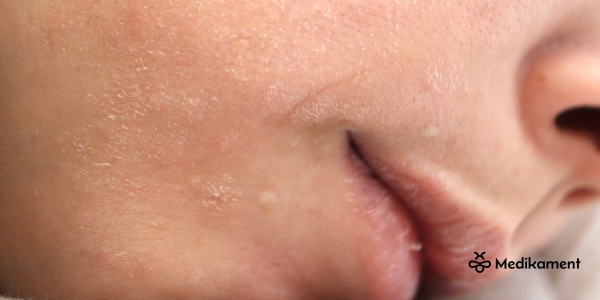 such&aacute; pokožka na tv&aacute;ri